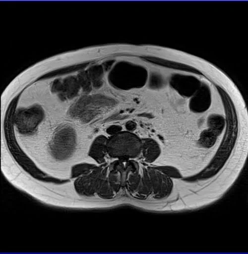 gyne pelvis ca endometrium axial big fov t1 3 - MRI