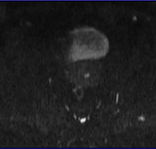 gyne pelvis ca endometrium axial dwi b500 - MRI