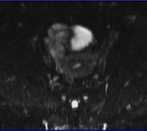 gyne pelvis ca endometrium axial dwi bo - MRI
