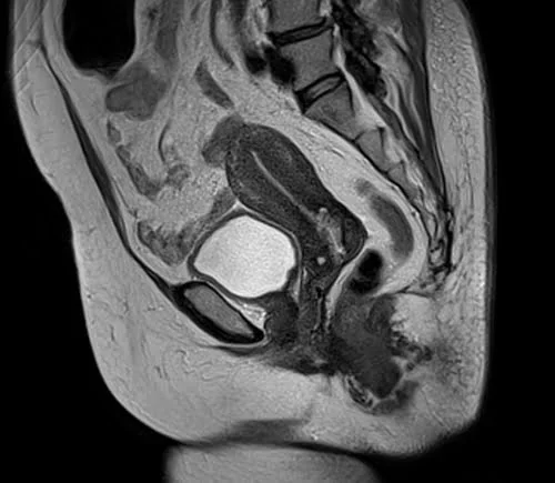 gyne pelvis ca endometrium sag image 2 - MRI