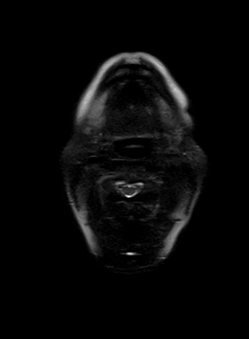 hast 3mm 1 - MRI