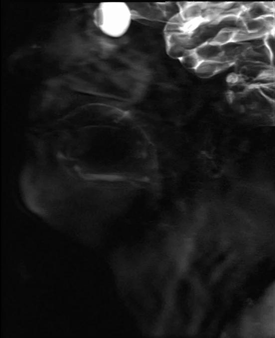 hast 60mm loc subma - MRI