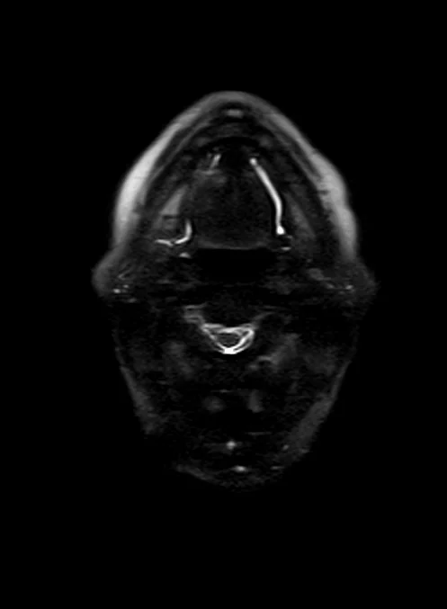 haste 3mm 2 - MRI