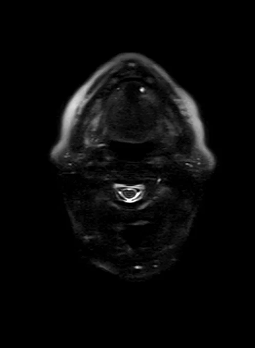haste 3mm 3 - MRI