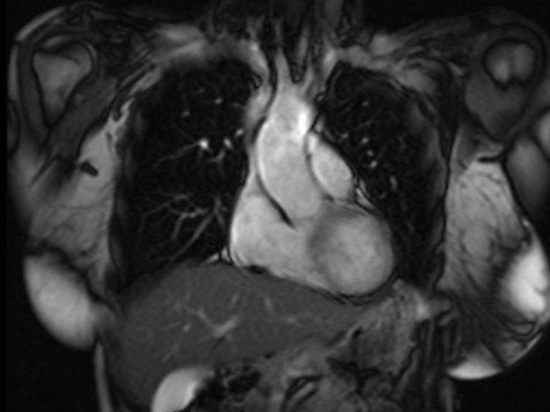 heart mri localizer 1 - MRI