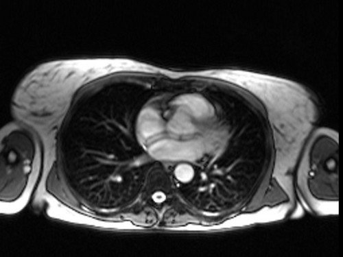 heart mri localizer - MRI