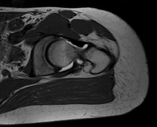 hip arthrogram ax oblique t1 image 1 - MRI