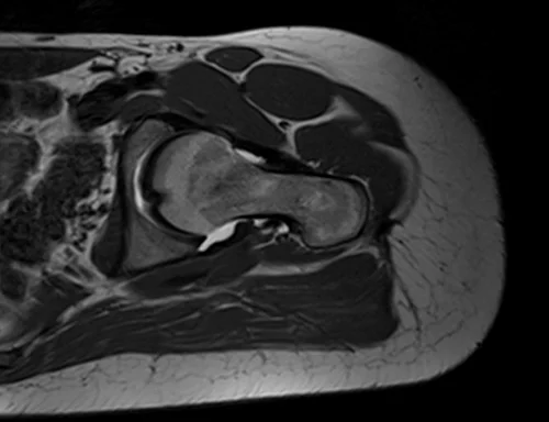 hip arthrogram ax oblique t1 image 2 - MRI