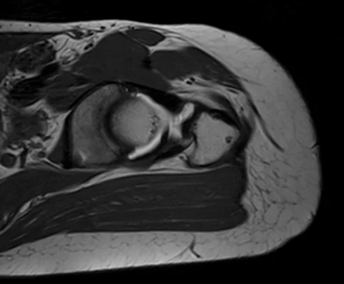 hip arthrogram ax oblique t1 image 3 - MRI