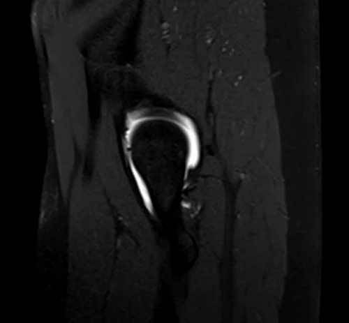 hip arthrogram sagittal t1 fs image 1 - MRI