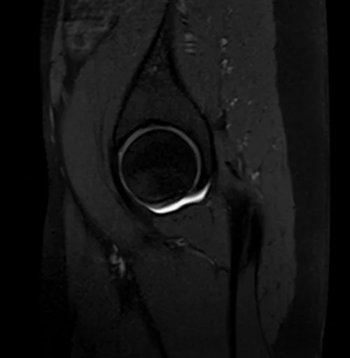 hip arthrogram sagittal t1 fs image 2 - MRI