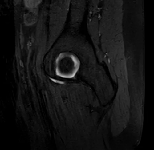 hip arthrogram sagittal t1 fs image 3 - MRI