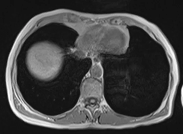 in ph 1 - MRI