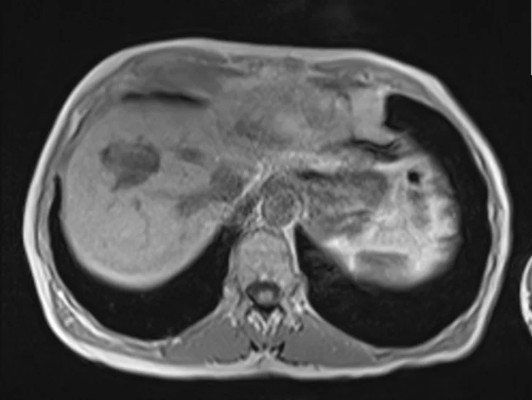in ph 2 - MRI