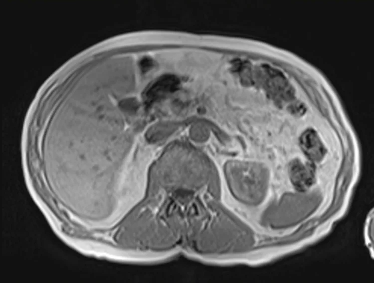 in ph 4 - MRI