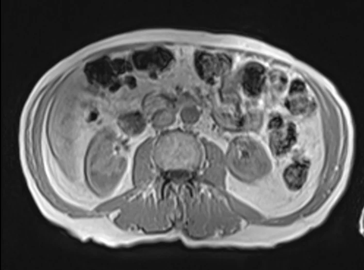 in ph 5 - MRI