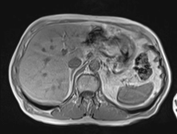 in ph3 - MRI