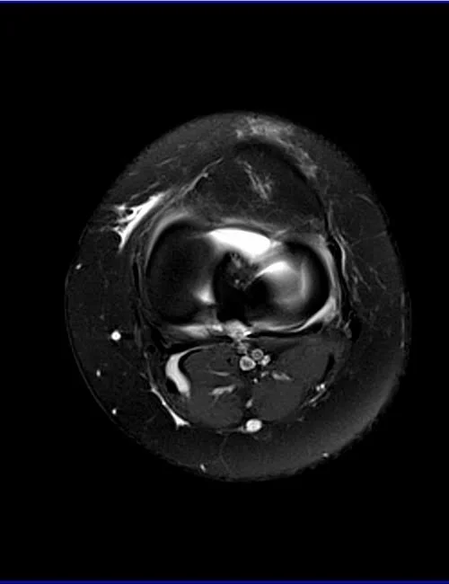 knee axial pd image 1 - MRI