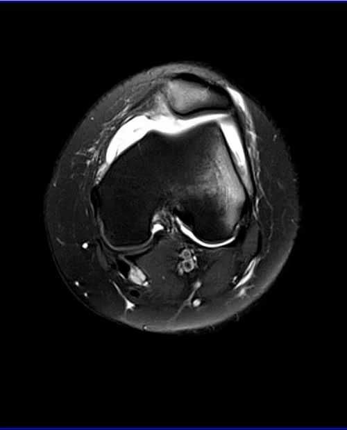 knee axial pd image 2 - MRI