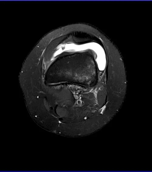 knee axial pd image 3 - MRI