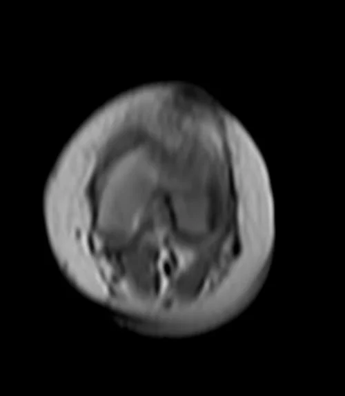 knee loc 1 - MRI