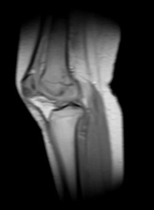 knee loc 2 - MRI