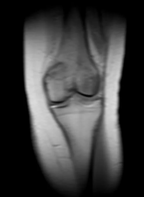 knee loc 3 - MRI