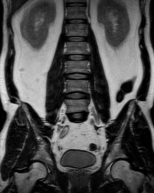 l plexues space 3d coronal image 1 - MRI