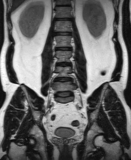 l plexues space 3d coronal image 2 - MRI