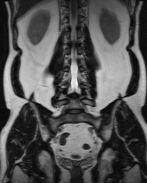 l plexues space 3d coronal image 3 - MRI