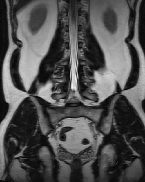 l plexues space 3d coronal image 4 - MRI