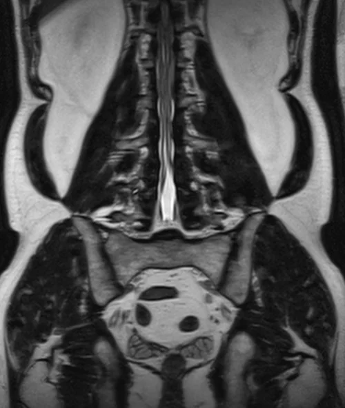 l plexues space 3d coronal image 5 - MRI