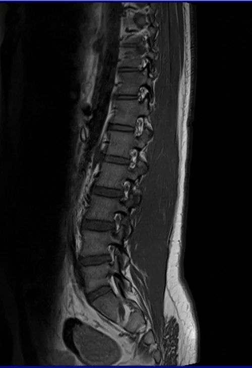 l spine sag t1 image 1 - MRI