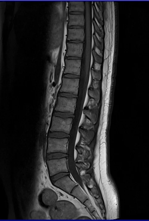 l spine sag t1 image 2 - MRI