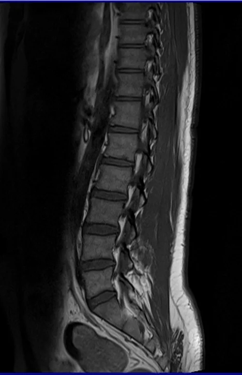 l spine sag t1 image 3 - MRI