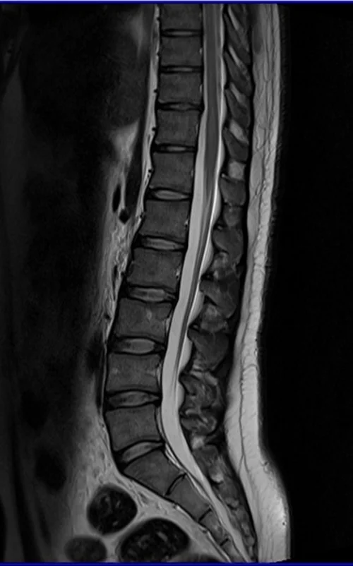 l spine sag t2 image 2 - MRI