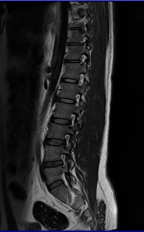 l spine sag t2 image 3 - MRI