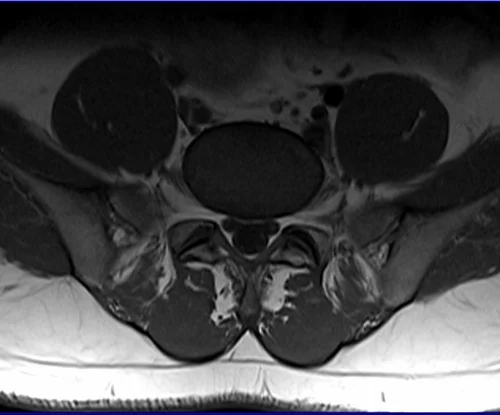 l spine t1 axi image 3 - MRI