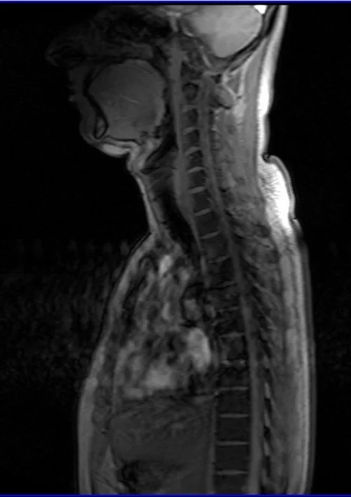 loc 2 - MRI