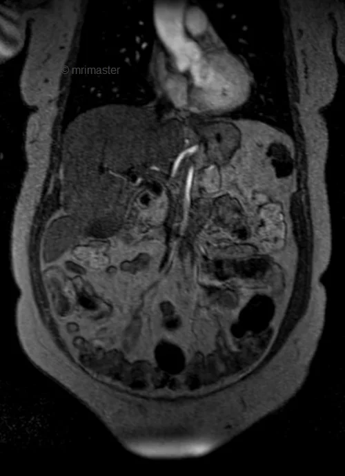 mra abdomen coronal flash image 2 - MRI