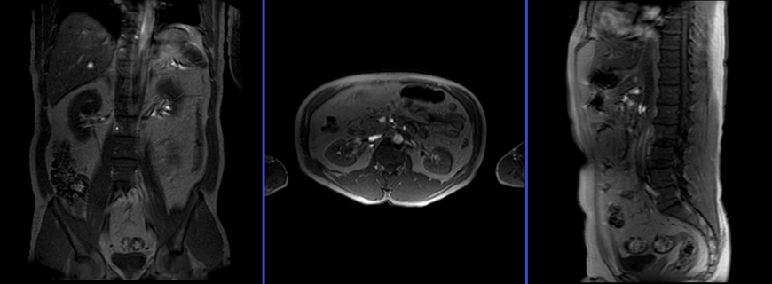 magnetic resonance angiography(MRA) whole body abdomen localizer