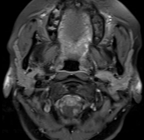 mra neck axial ti fat sat image 1 - MRI