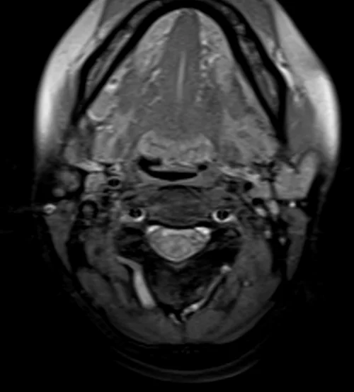 mra neck axial ti fat sat image 2 - MRI
