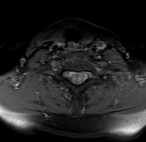 mra neck axial ti fat sat image 4 - MRI