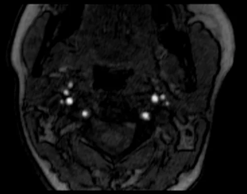 mra neck axial tof image 2 - MRI