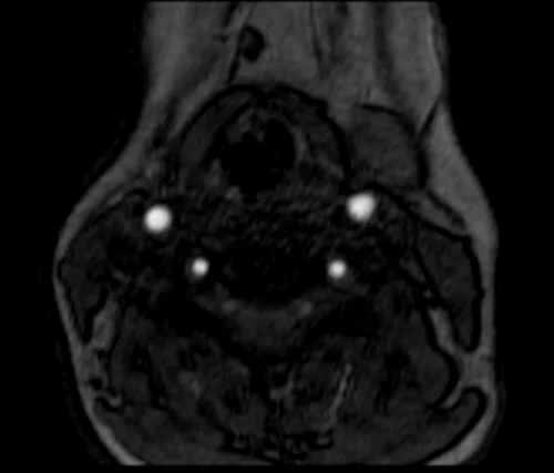mra neck axial tof image 3 - MRI
