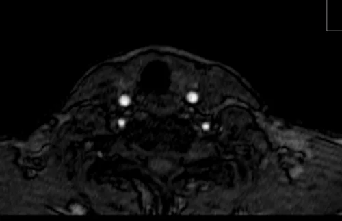 mra neck axial tof image 4 - MRI
