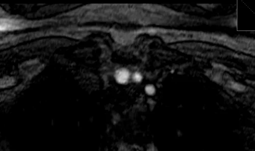 mra neck axial tof image 5 - MRI