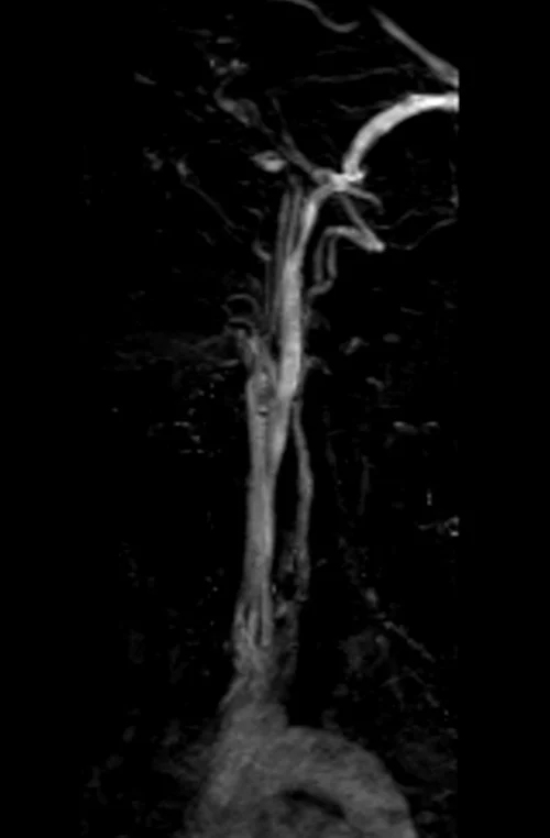 mra neck vascular localizer image - MRI