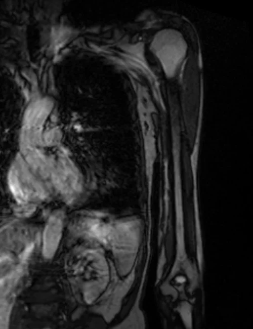 mra upper arm loc 1 - MRI